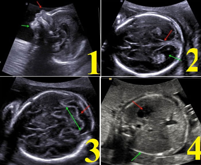 anomaly scan 4 - کلینیک سونوگرافی و رادیولوژی مهرسان