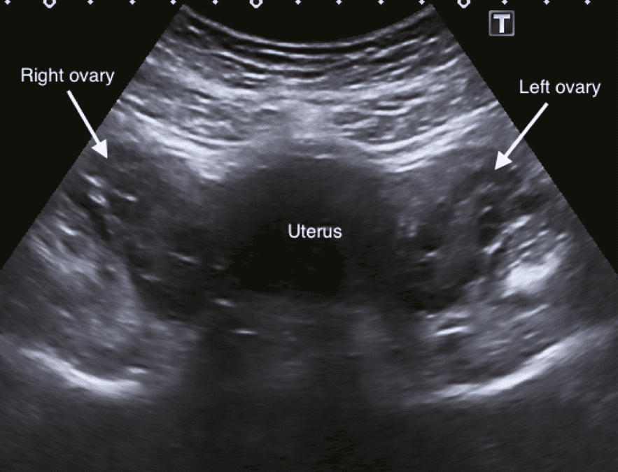 سونوگرافی رحم و تخمدان چگونه است ؟