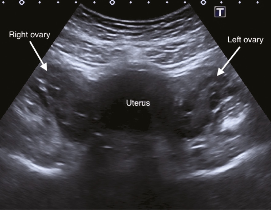 سونوگرافی رحم و تخمدان ها